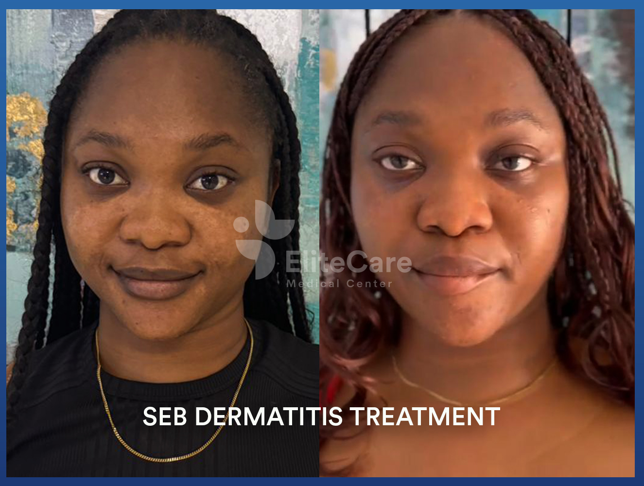 seb-dermatitis-treatment-by-a-dermatologist-in-ghana