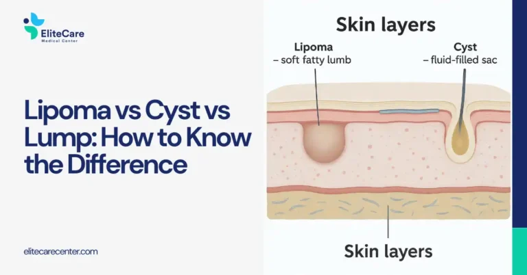 Lipoma vs Cyst vs Lump: How to Know the Difference