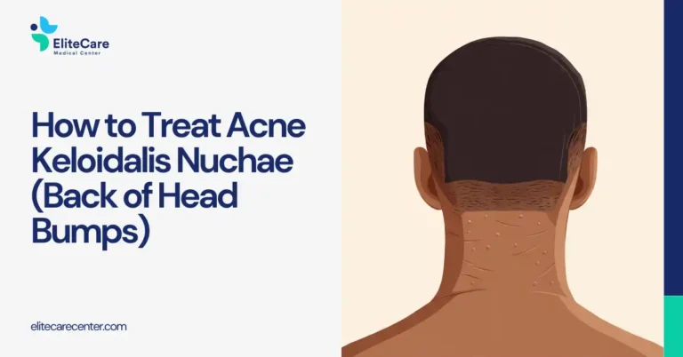 How to Treat Acne Keloidalis Nuchae (Back of Head Bumps)